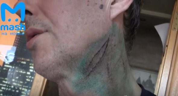 Порезы на шее Караваева